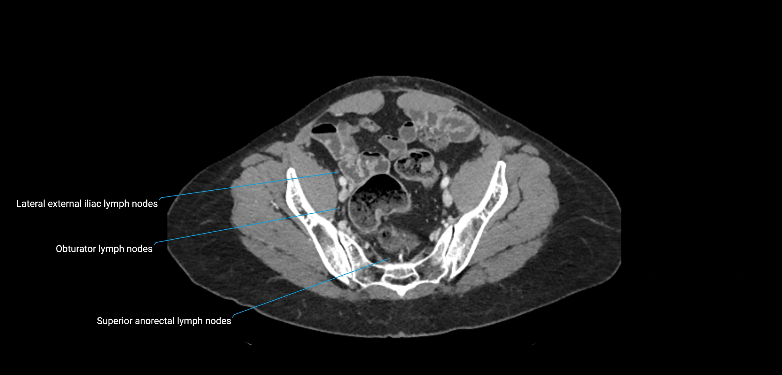 CT ct abdominal lymph nodes  axial cross sectional anatomy  enchanced radiology image -img-00002-00343.webp